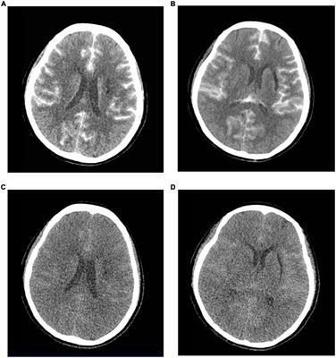 Contrast-induced encephalopathy and permanent neurological deficit following cerebral angiography: A case report and review of the literature